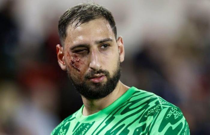 Nasty wound for PSG goalie: Horror injury: Gigi Donnarumma gets studs in his face