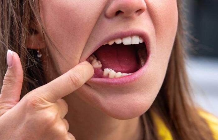 No more holes in the teeth, the Japanese have found a medicine to regrow teeth