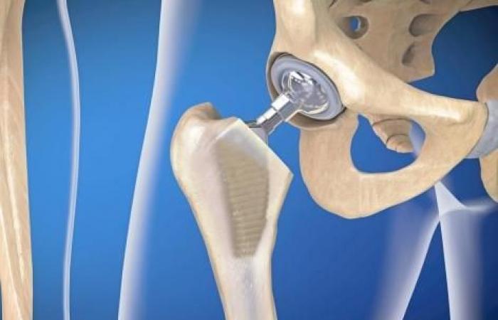 Partial suspension of a clinical trial on a total hip prosthesis: should you consult?