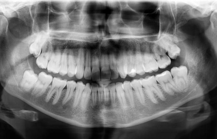 Japanese researchers unveil treatment to regrow teeth