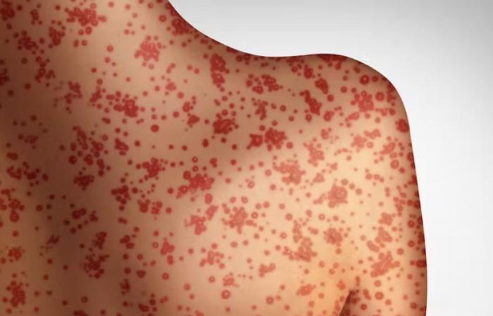 Measles: Why deaths are increasing and how to prevent them