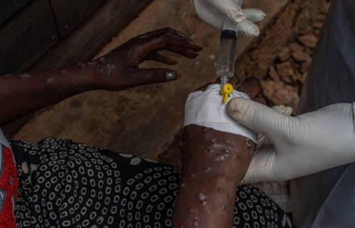 Belgium reports first case of new mpox variant