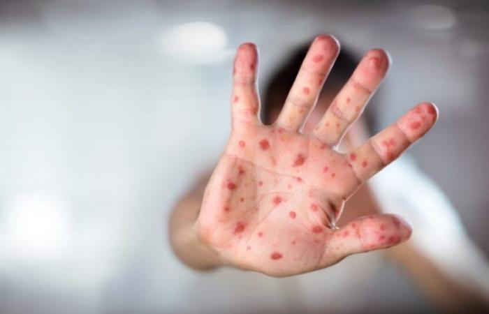 Tangier: the increase in measles cases worries