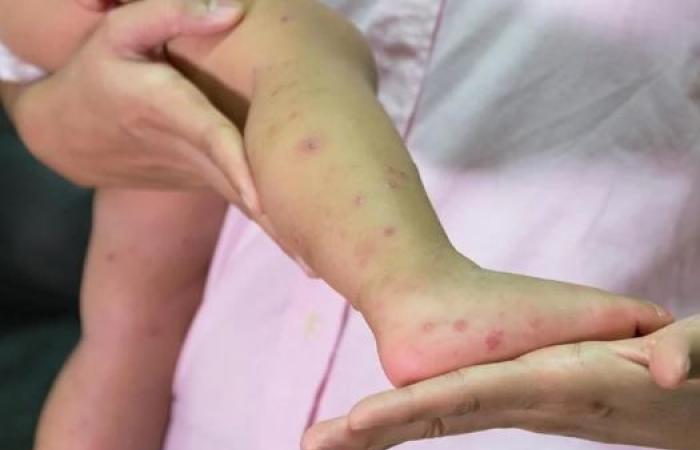 The Ministry of National Education extends the measles awareness campaign