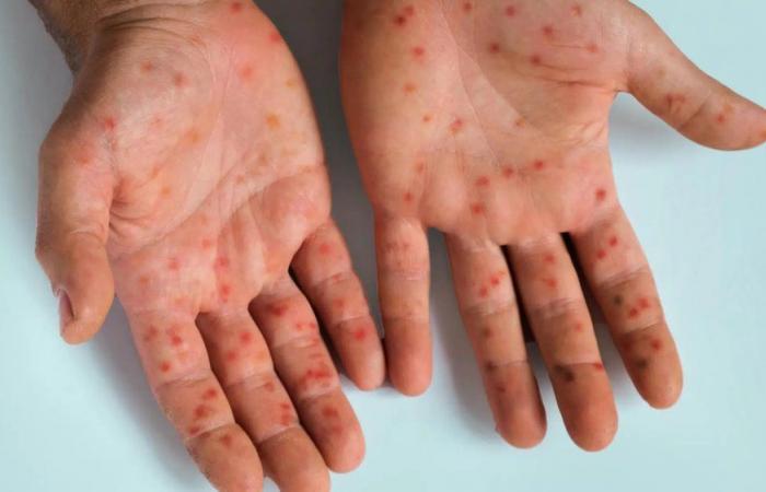 Measles spreads in Morocco, vaccination on the front line to avoid an epidemic