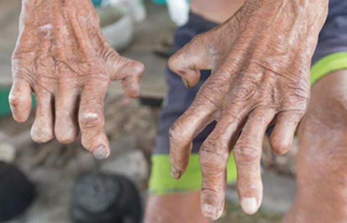 Leprosy still present in Morocco – Today Morocco