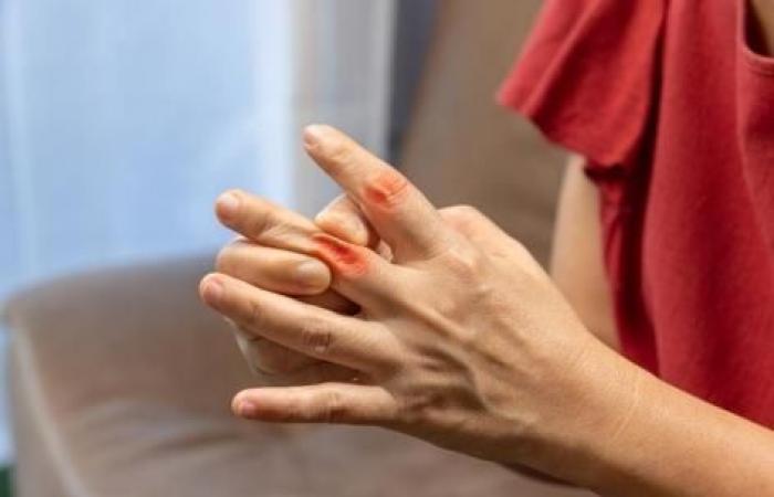 Rheumatoid arthritis: watch out for anemia!