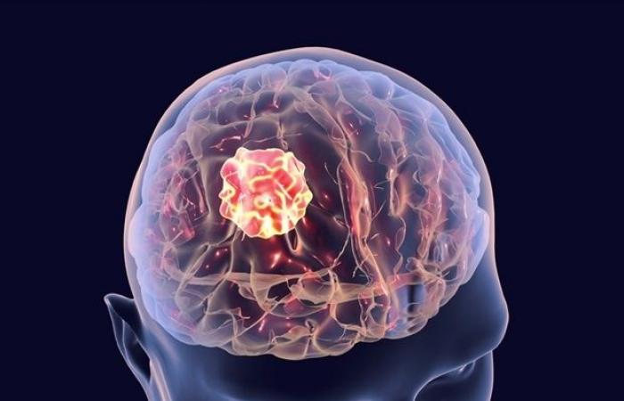 Study identifies best imaging methods to assess brain tumor response in melanoma patients