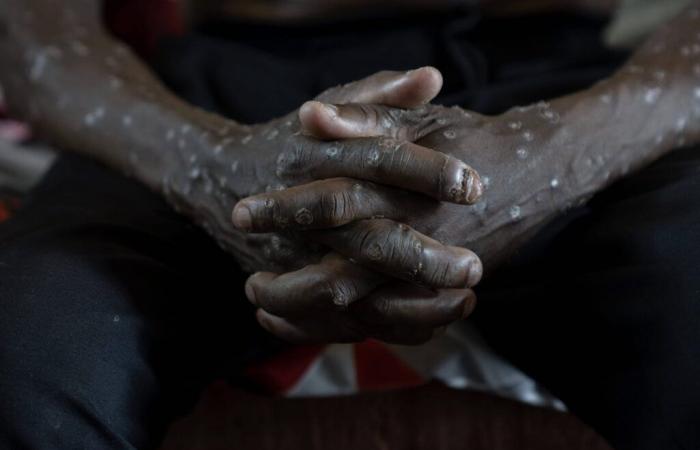 Symptoms, variant, situation in France… 4 questions about mpox