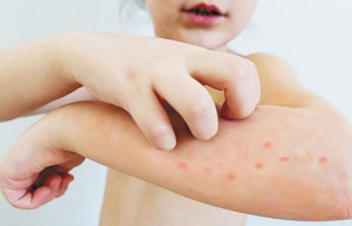 Measles outbreak ends in Fredericton area