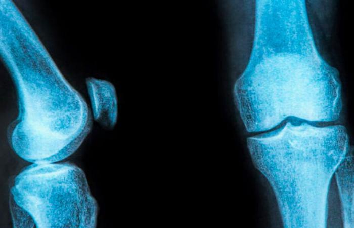 25% of women over 45 exposed to the risk of osteoporosis