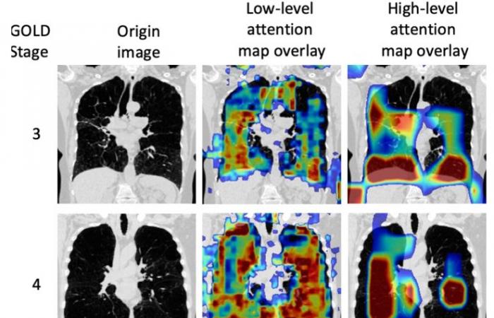 Diagnosis of COPD by one-shot CT aided by a neural network