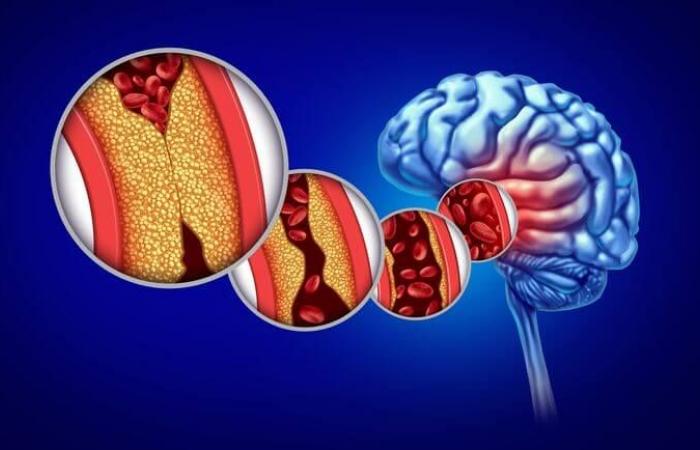 new dosage at 5,000 U indicated in the treatment of stroke