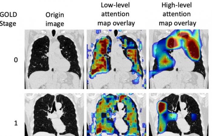 Diagnosis of COPD by one-shot CT aided by a neural network