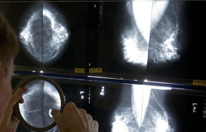 Artificial intelligence to detect breast cancer