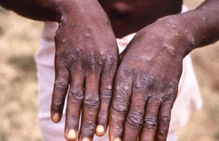 27-year-old man: Sierra Leone reports first confirmed case of mpox