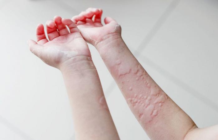 Cold allergy or urticaria: causes, symptoms and how to cope in winter