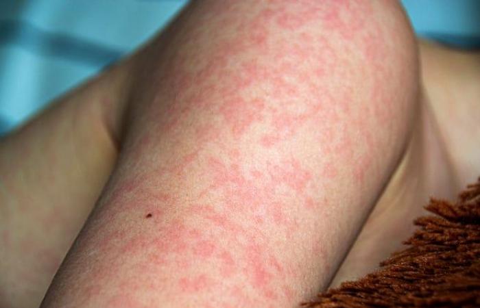 Quebec calls for vigilance following 11th case of measles