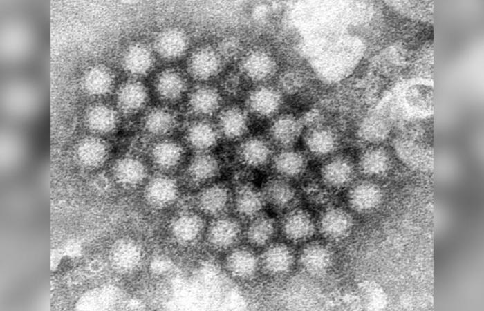 Norovirus is gaining ground in Canada: a doctor’s advice for dealing with this illness