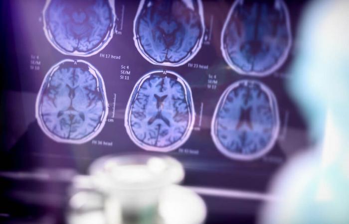 4 million euros to advance Alzheimer’s research