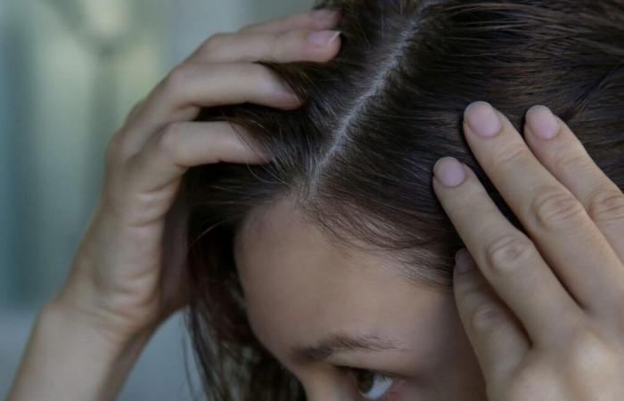 Why do 20-30 year olds have gray hair earlier and earlier?