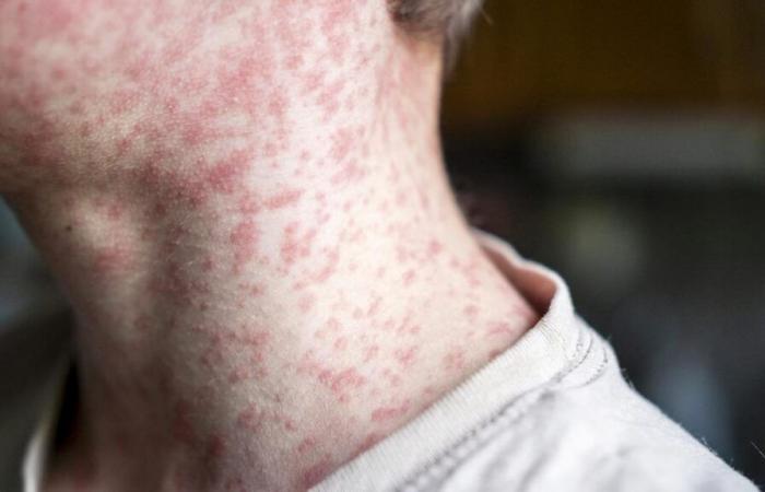 Cases of measles in the Laurentides region