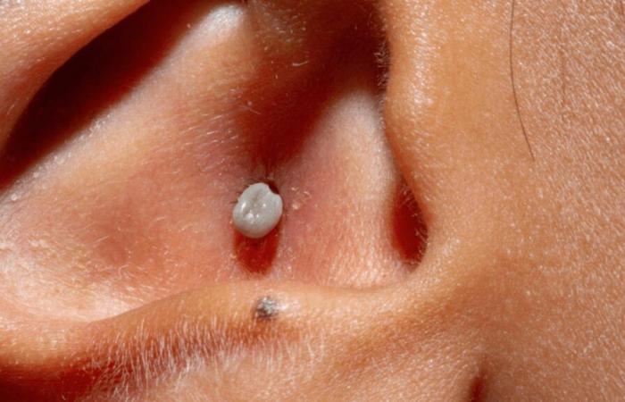 A tick gets stuck in her ear: a woman almost goes deaf