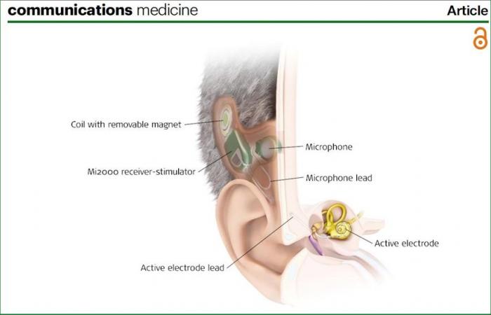 1st European study on the benefits of fully implantable implants