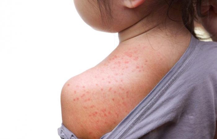 Measles: call for vigilance in the Laurentians