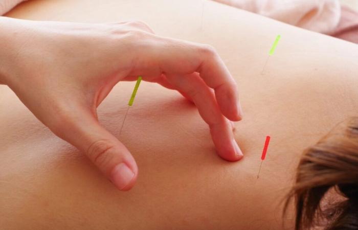 Acupuncture proves effective against sciatica