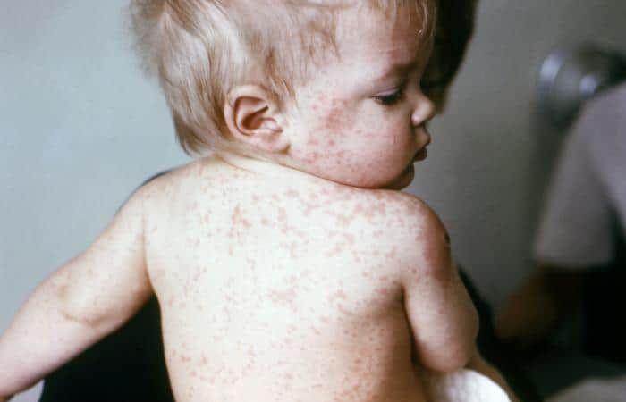 Six things to know about measles outbreaks in Quebec