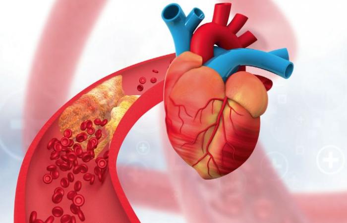 Should SGLT2 inhibitors be prescribed after myocardial infarction with left ventricular dysfunction?