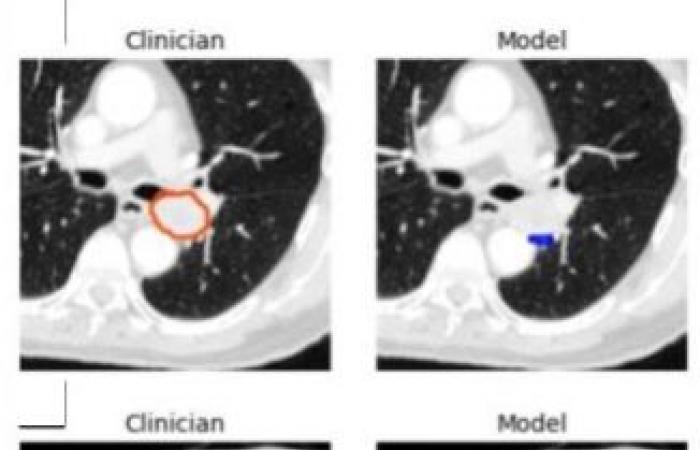 An effective AI tool for CT lung tumor segmentation