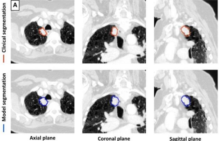 An effective AI tool for CT lung tumor segmentation