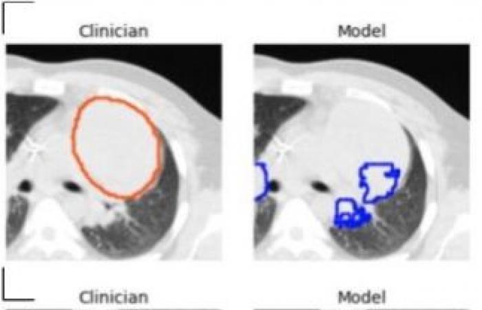 An effective AI tool for CT lung tumor segmentation