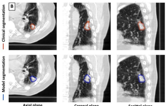 An effective AI tool for CT lung tumor segmentation