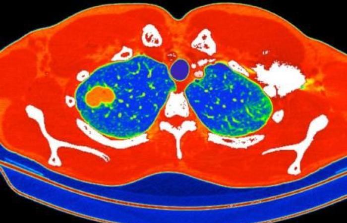 Organized lung cancer screening: the pilot program is finally launched