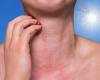 How to recognize a sun allergy (and what to do)?