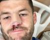 Stade Toulousain: “It’s time to fix the nose…” Blair Kinghorn operated on again after his shock in the Champions Cup final