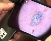 VIDEO – Artificial intelligence, a valuable aid in detecting skin cancer