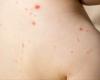 Measles outbreak in Fredericton area