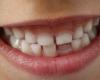 What is MIH, this disease that destroys the enamel of children’s teeth and promotes cavities?