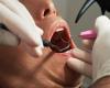 Dental implants soon to be fully reimbursed?