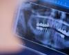 Will dental implants soon be reimbursed in France? – Liberation