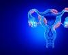 Endometriosis: a discovery could explain the pain and growth of lesions