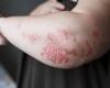 Zasocitinib, another Tyk2 inhibitor to treat oral psoriasis