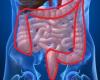 why colon cancer affects increasingly younger patients?