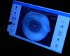 In the Province of Luxembourg, we detect diabetic retinopathy using AI!