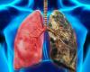 Lung cancer remains an urgent global challenge in the Middle East and Africa (LAA)