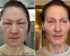 ‘Project Baby Face’ Fat Injections Cause Entrepreneur’s Face to ‘Blow Up’